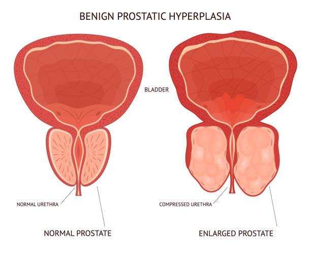 Enlarged Prostate Symptoms